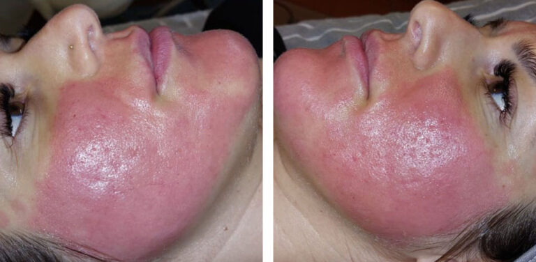 Direkt nach der Behandlung