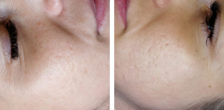 Zwei Tage nach der Behandlung